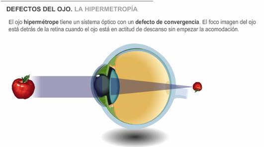 Lente ocular 2025 del ojo